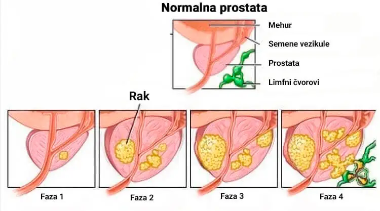 ProDrops: Prirodno rešenje za zdravlje prostate - eliminiše upalu, poboljšava mokrenje i smanjuje rizik od raka."